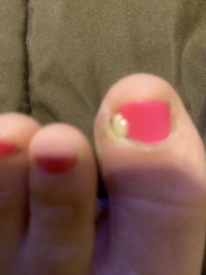 I almost lost my toe !!!