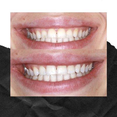 minimally invasive dentistry. Smile improvement with direct composite restorations