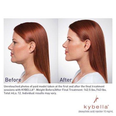 Kybella