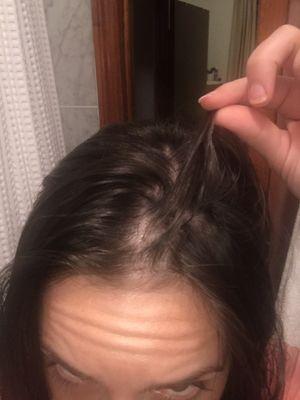 Three weeks later...hair loss in from the burnt area increasing.