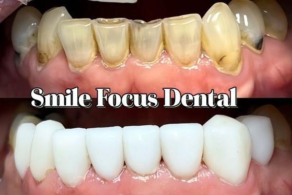 Lower veneers