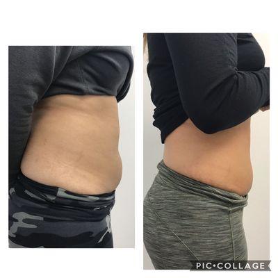 After just 2 fat reduction treatments.