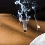 Moxabustion (heat therapy) at Endless Possibilities Acupuncture, Inc.