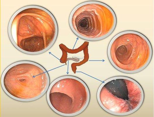 "COLONOSCOPY IN FRESNO" https://www.facebook.com/colonoscopy.fresno/