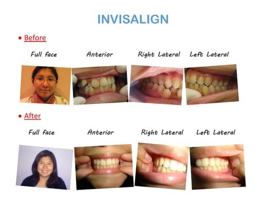 Preferred provider with ITero scanning (Invisalign).