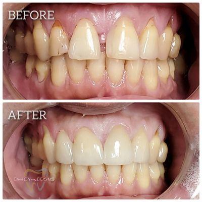 Updated Photo Patient Gingiva (gum) filled in