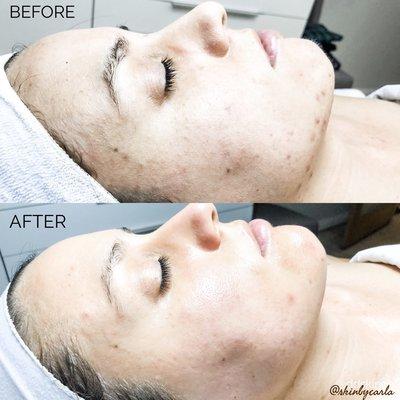 Consistency is key on treating acne.