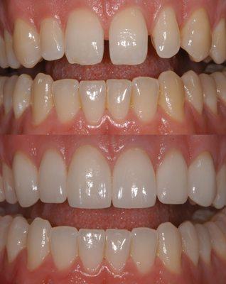 Veneers