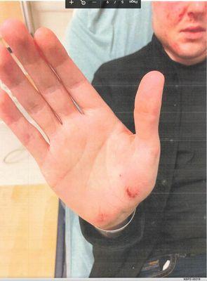 Lacerated palm from being pushed down from behind trying to run away by trenhead Marine Aryton Bryant during near-fatal 30min attack.