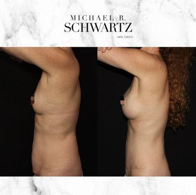 This is our 54 year old patient who received a tummy tuck with liposuction to her flanks.