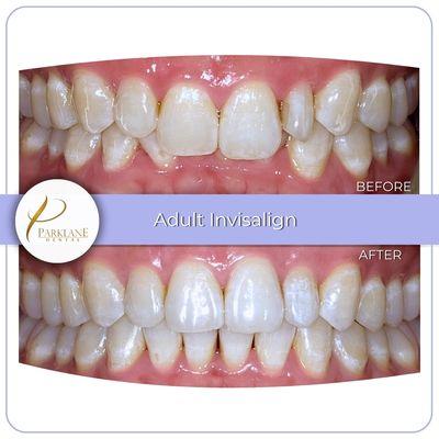 Thanks to Invisalign treatment, patient's overbite is corrected and teeth is straightened!