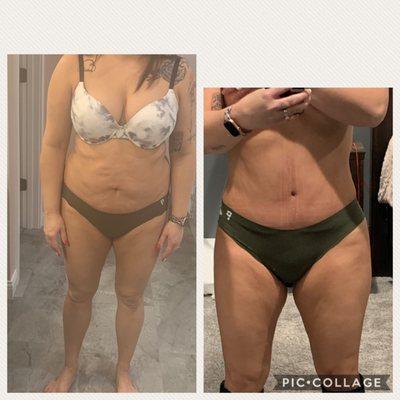 Before and after. Same weight in both pics. Lipo to flanks and TT.