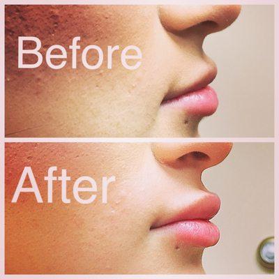 Perfect pout thanks to Restylane with Dr. Flugstad! Patient treated with 1 cc of Restylane to plump her lips.