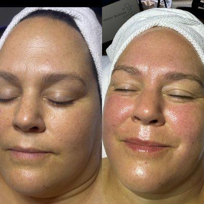 Hydrofacial, Oxygen Therapy