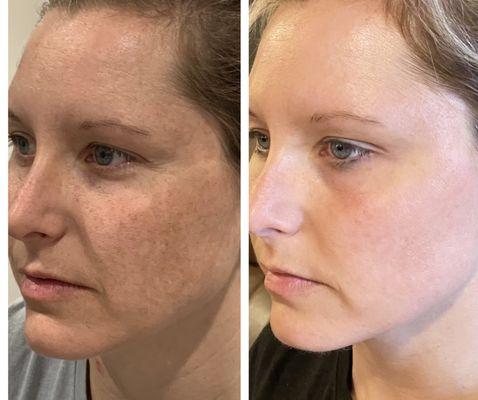 Melasma Reduction