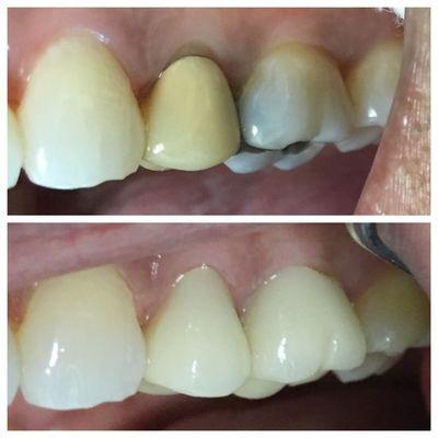 Porcelain crowns