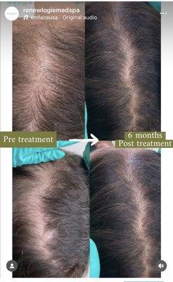 Hair restoration at Renewlogie with PRP injections and Pepfactor peptide microneedling. Series of 3 recommended.