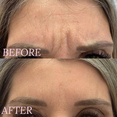 Frown lines have disappeared by treating the glabellar complex with Botox