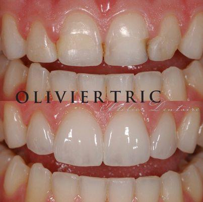 Before & After: practicing conservative dentistry to preserve to tooth substructure, we created 4 lifelike and translucent porcelain veneers