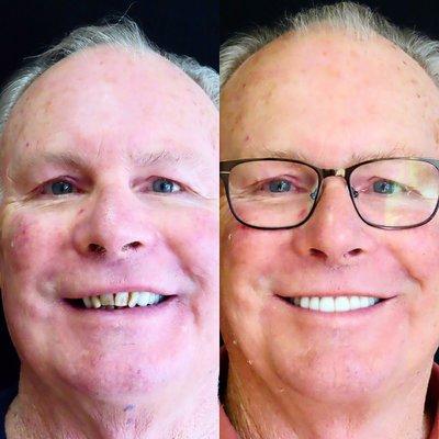 Before and After Implant Supported Zirconia bridges. Now that's one good lookin guy!