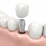 Dental Implants replace your own natural teeth when lost due to decay or periodontal disease...