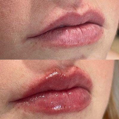 1ml of Versa was used to augment this clients lips. She wanted to enhance her already beautifully shaped lips.