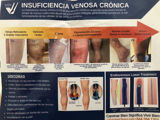 Educational flyer about chronic vein insufficiency