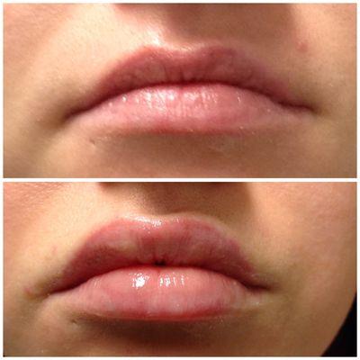 Lips before Versa filler and after