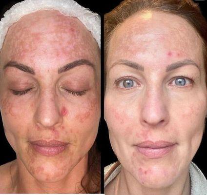 Before and after Aerolase for acne and melasma