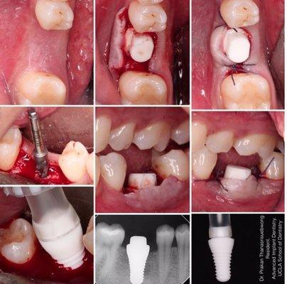 This patient from California was missing a molar. The bone thickness was good to place the CeraRoot 16 specifically designed for molars.