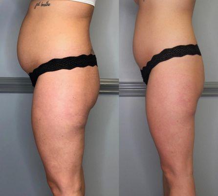 Cryoskin Fat Reduction