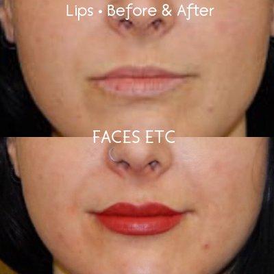 Lips - Before & After