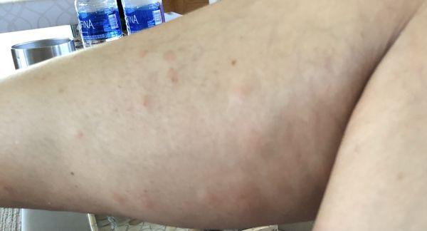 My wife leg bitten up by mosquitoes in the apartment