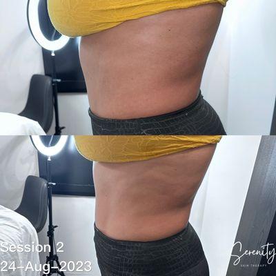 Fat reduction and cellulite reduction with body sculpting