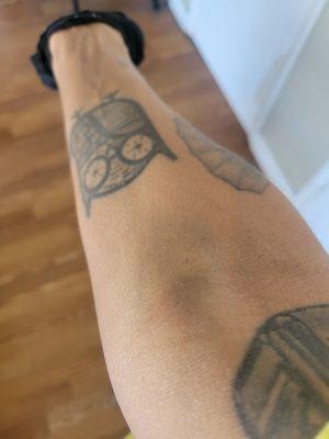 A few days later... still huge blue bruise and now purple, too