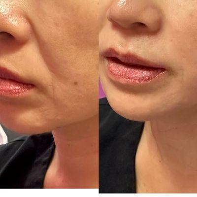 Nasolabial fold filler before and after