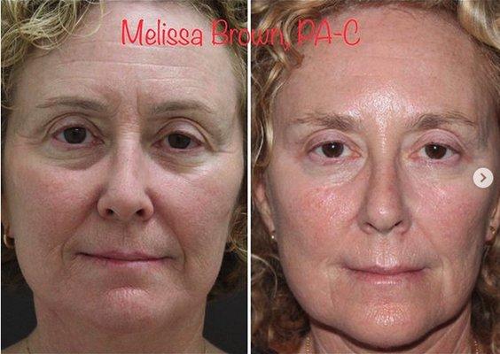 This is a mix of Fillers, Botox, and Signature Laser therapies (CAT peels). All work NON-SURGICAL!!