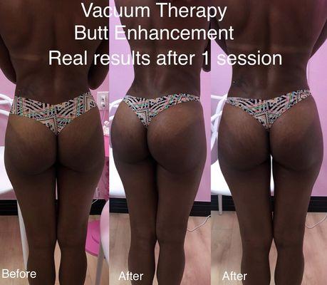 Vacuum Therapy butt plumping treatment for enlargement and lifting