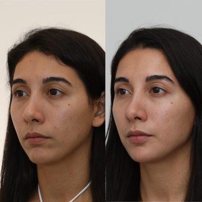 We used Botox and filler to refresh the undereye area, cheeks, chin, and lips. The key is to keep you looking un-injected.