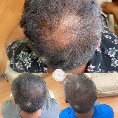 Scalp Micropigmentation smp