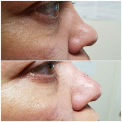 Non-surgical nosejob with Juvederm Voluma.