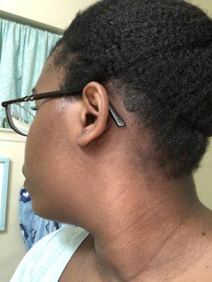 SK- seborrheic keratosis on my scalp