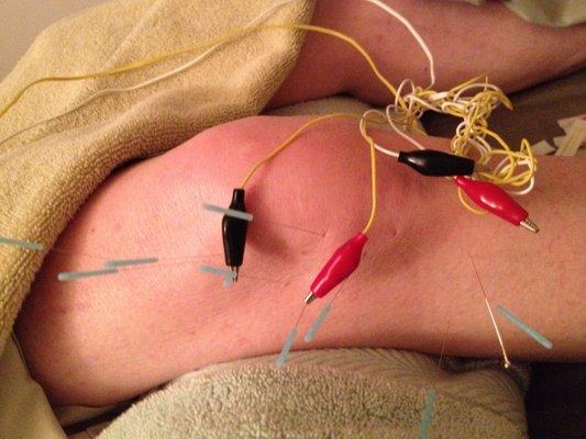 Electroacupuncture enhances the pain relieving and healing effect!