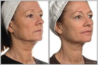 Non-invasive Facelift! Microcurrent and Ultrasound technology! REAL results that last