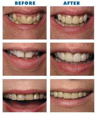 Brooklyn Dental Veneers