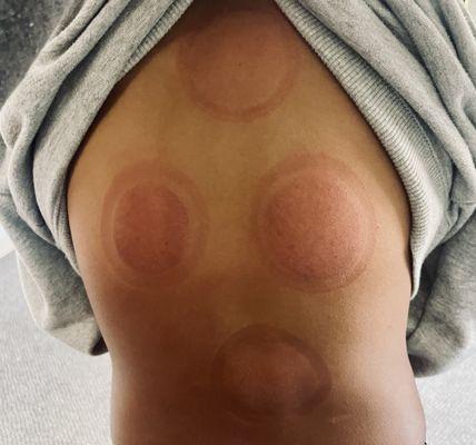 Totally recommend cupping.