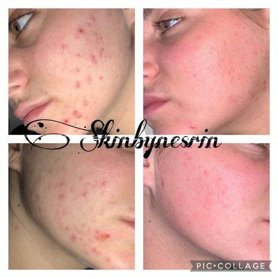 3 month progress Acne program