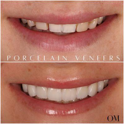 Patient was born without canines. Reshaped her teeth and redistributed the proportions with 8 porcelain veneers.