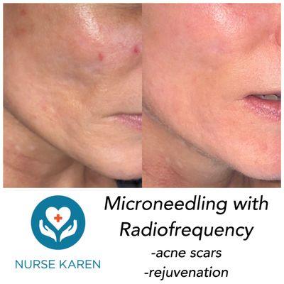 Microneedling with Radiofrequency, Microneedling RF, Best Microneedling in Austin, acne scar treatment, skin rejuvenation austin