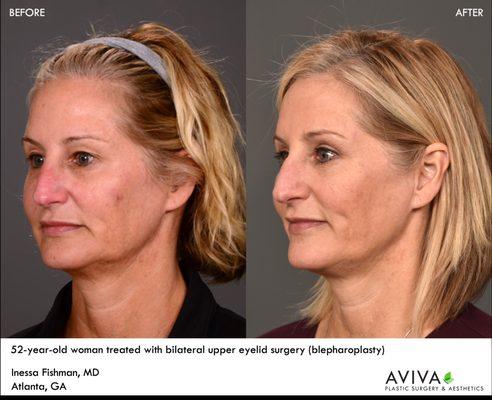 Blepharoplasty or lid lift allows for a more open, less tired appearance for the eyes.